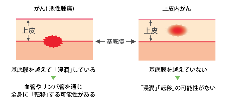 上皮 内 新 生物 と は